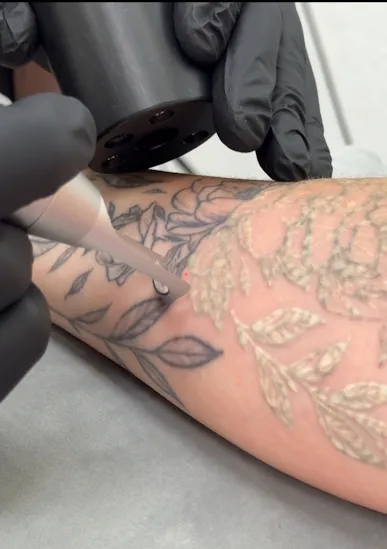 видалення тату