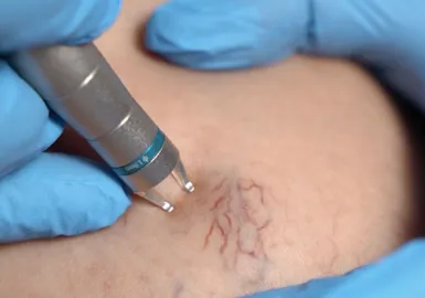 видалення судин