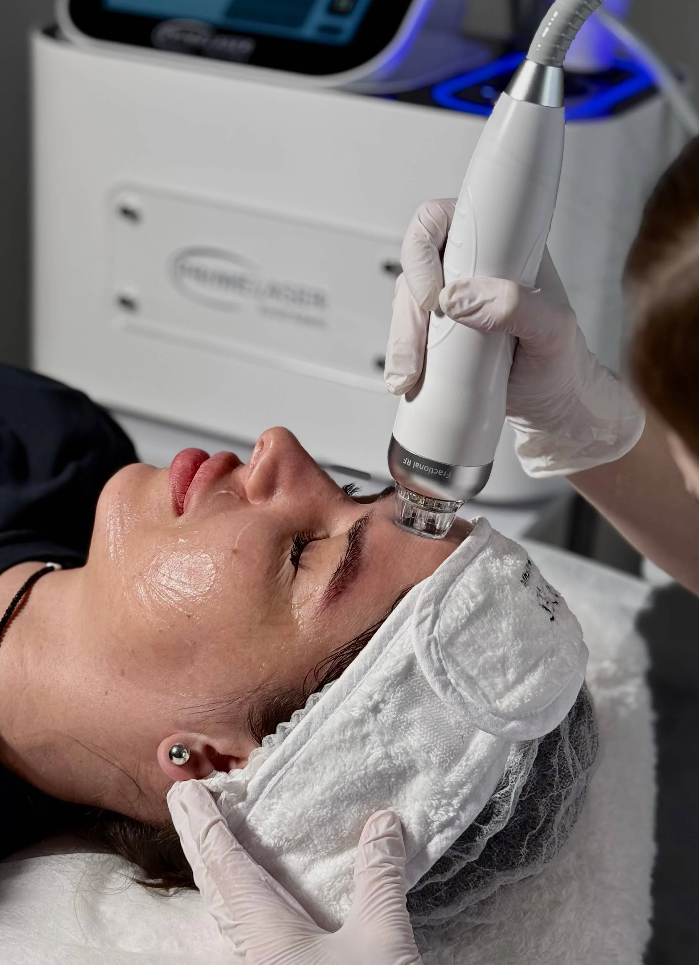 Безголковий / Мікроголковий RF-ліфтинг