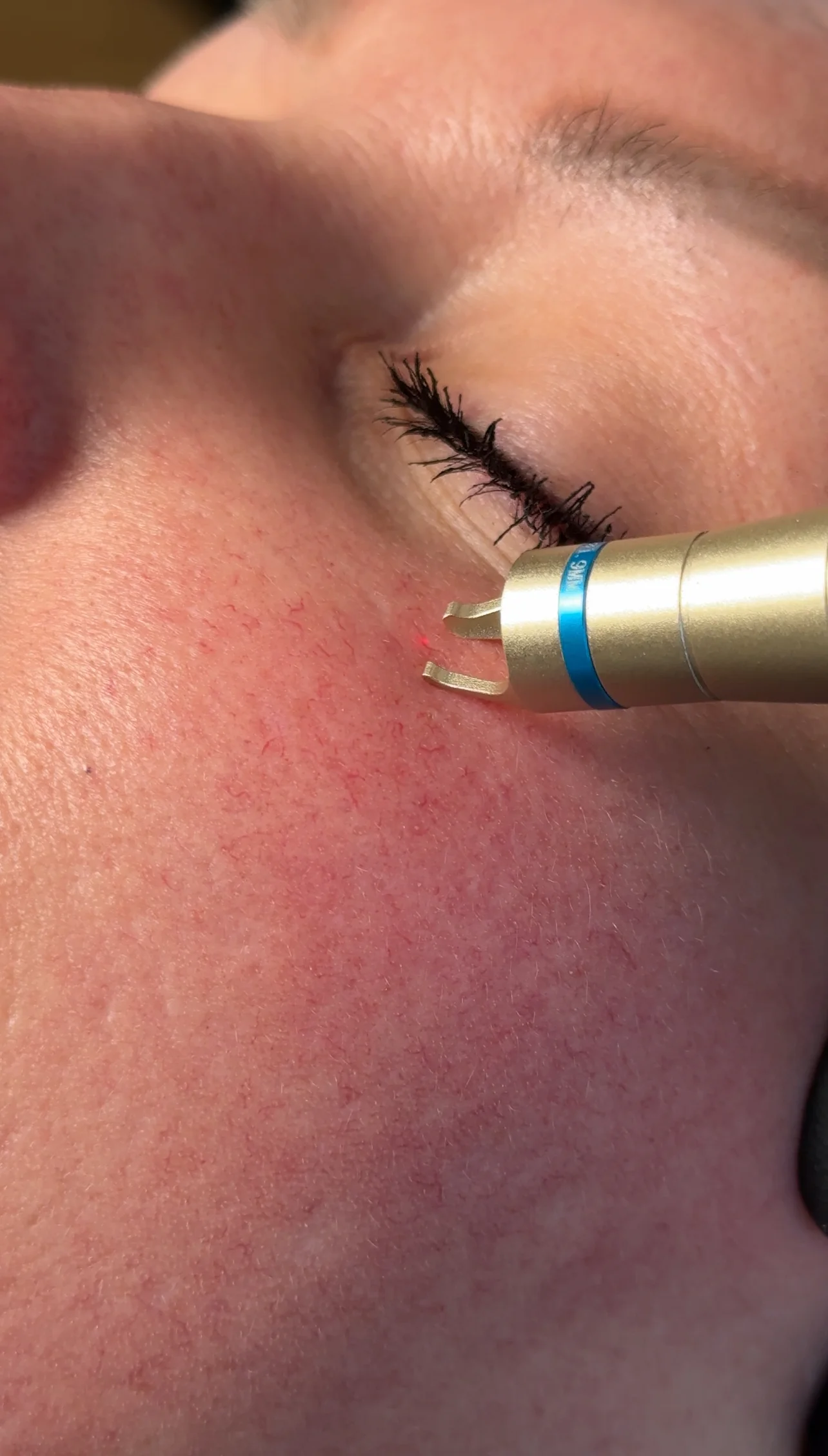 Лазерне видалення судин на обличчі та тілі